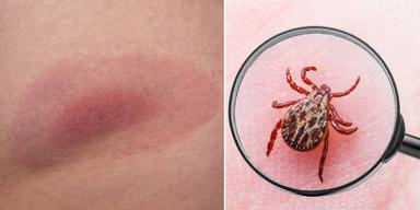 Borrelia har gett en röd ring på huden och en fästing på huden.