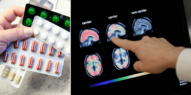 Pillerkartor till vänster och en hjärnscan av hjärnor med och utan alzheimer till höger.
