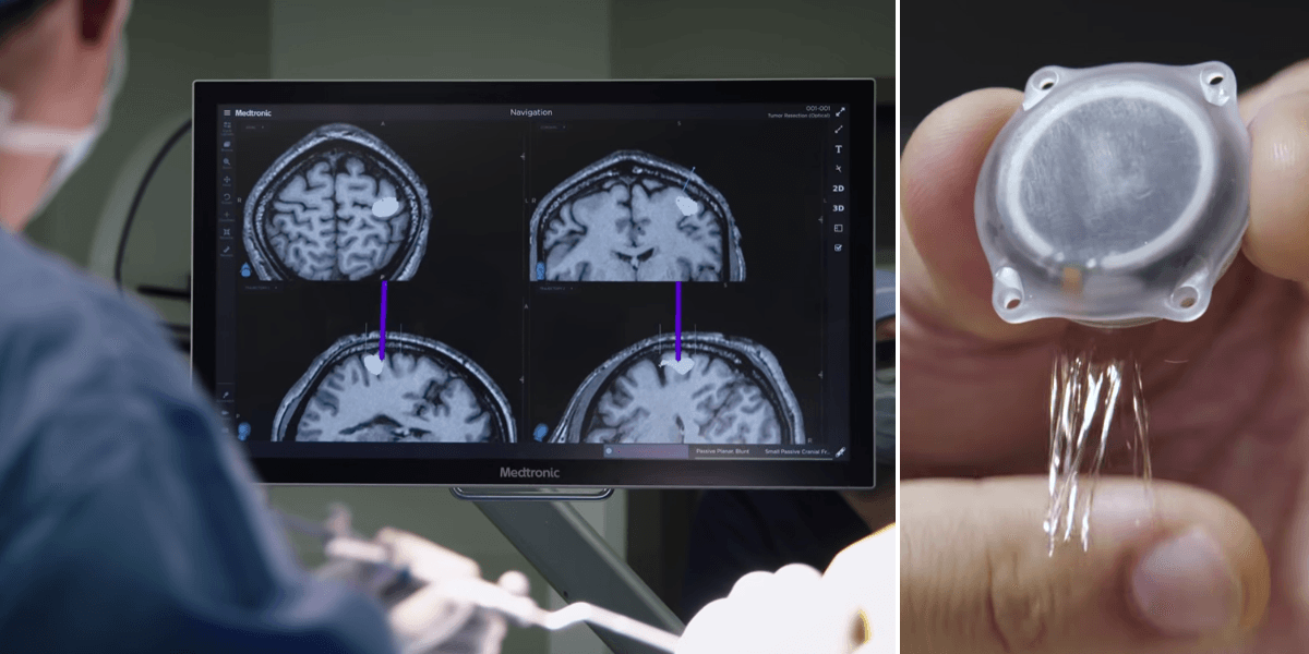 Hjärna på en person med ALS som får teknik inopererat.
