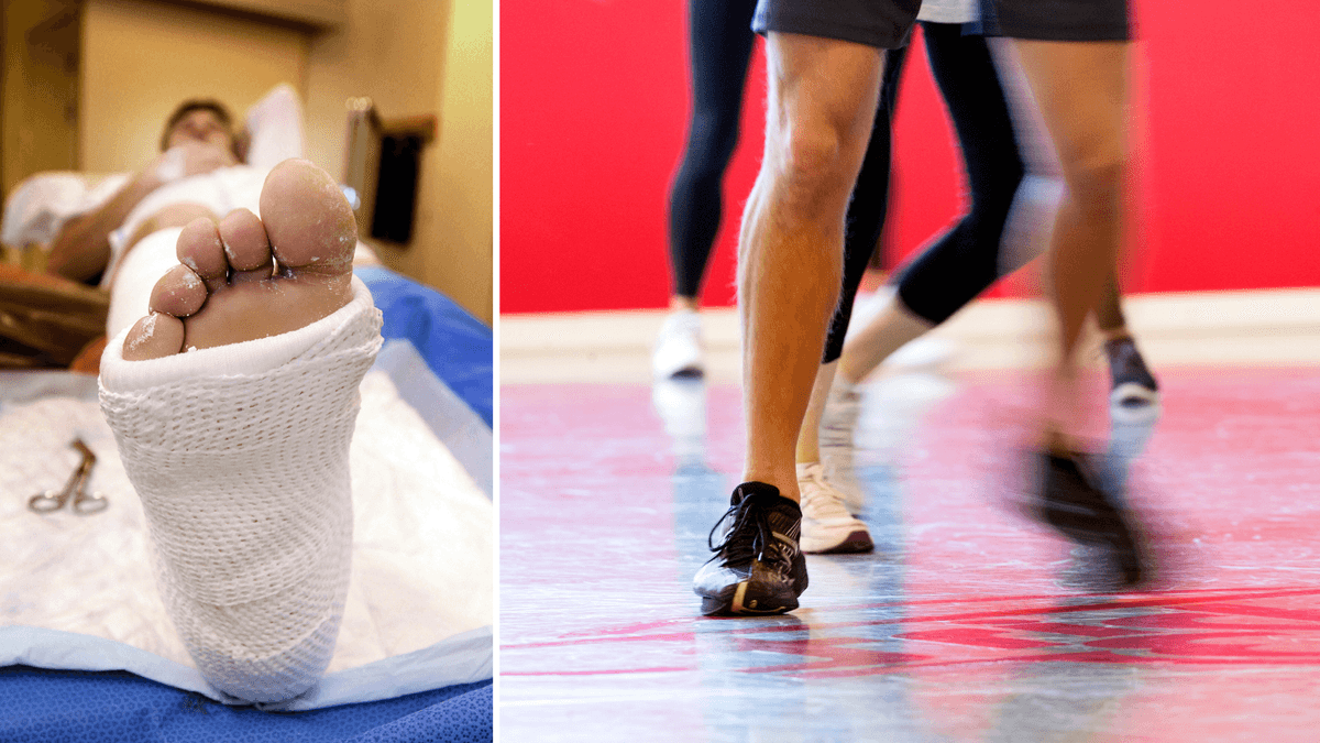 En person med brutet ben på grund av benskörhet till vänter och människor som tränar till höger.