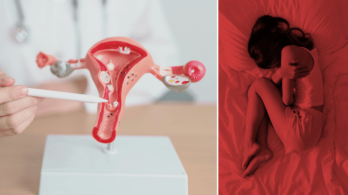 En modell av ett underliv med endometrios till vänster och en kvinna i fosterställning till höger.